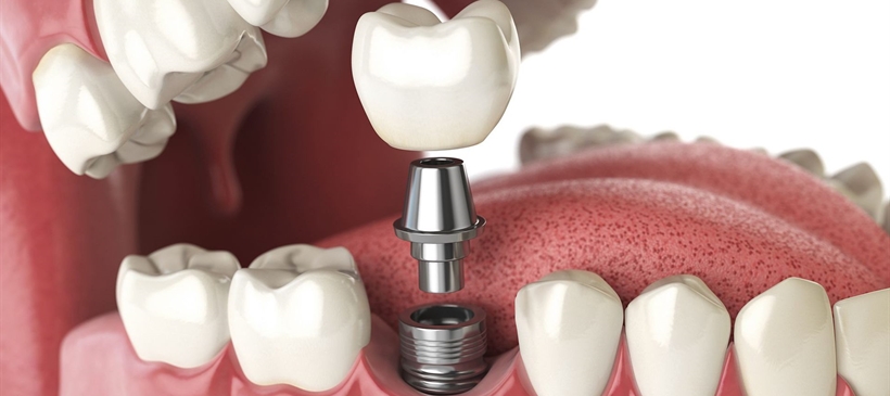 Dental Implants