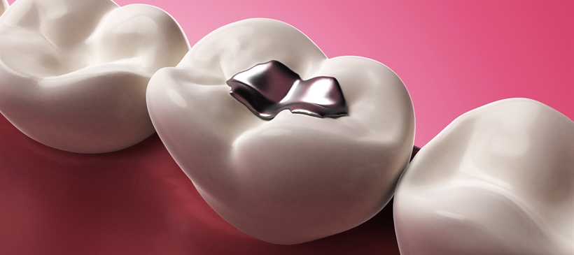Dental Filling